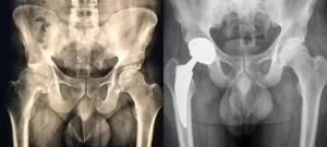 radiografie di un anca prima e dopo la protesi